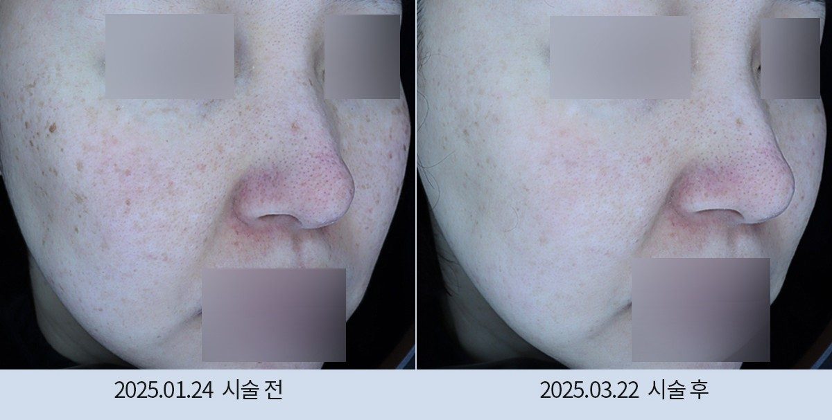 스노우의원 다산점 색소 시술 전후